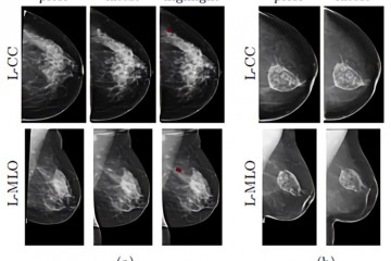 深度学习10万张乳房X光照片，纽大AI模型要帮助筛查乳腺癌